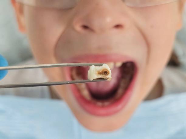 Best Teeth Whitening  in Zebulon, GA