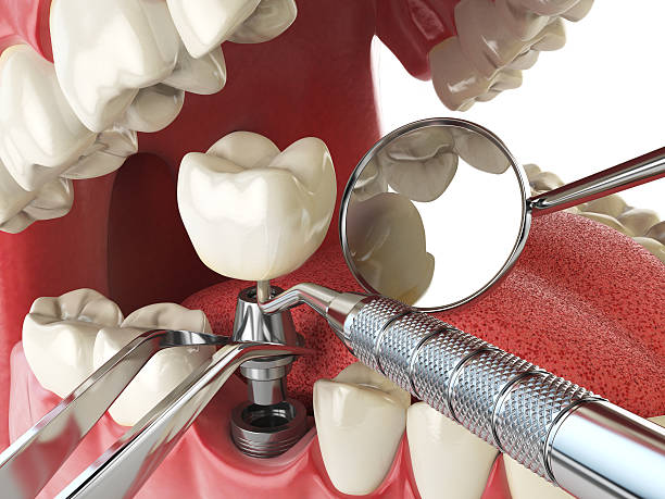 Best Chipped Tooth Repair Near Me  in Zebulon, GA